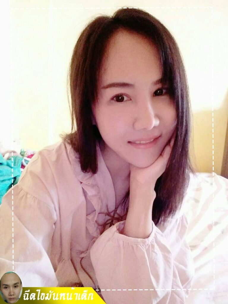 Review ฉีดไขมันหน้าเด็ก #99