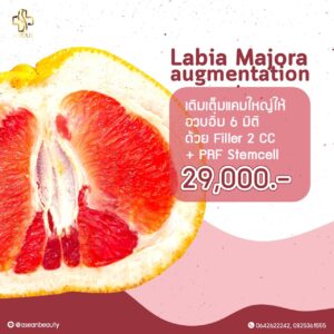 Promotion-LabiaMajoraaugmentation