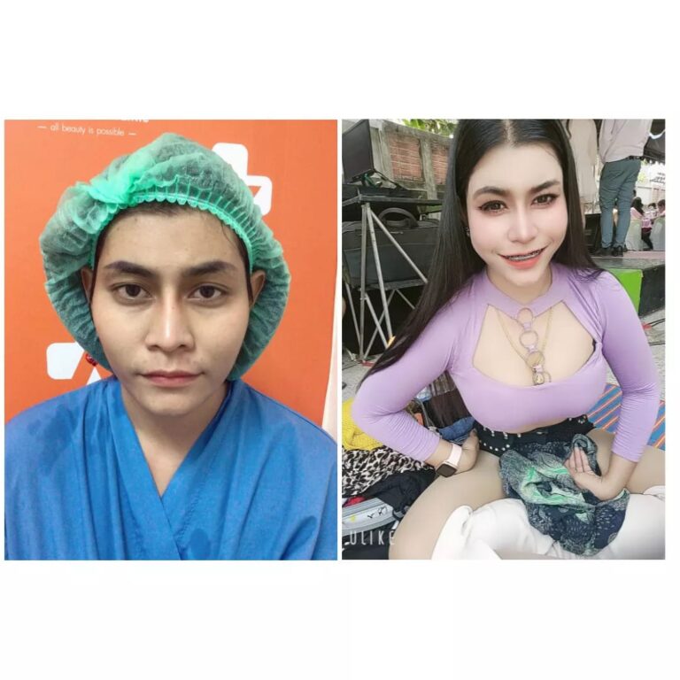 Review ฉีดไขมันหน้าเด็ก #102