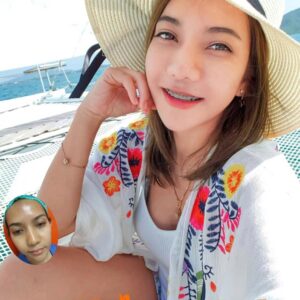 รีวิวฉีดไขมันหน้าเด็ก#104