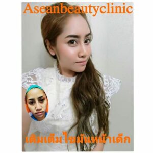 รีวิวฉีดไขมันหน้าเด็ก#105