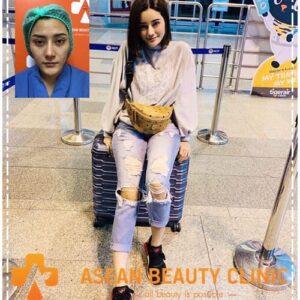 รีวิวฉีดไขมันหน้าเด็ก#106