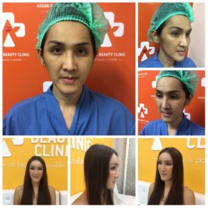 รีวิวฉีดไขมันหน้าเด็ก#107