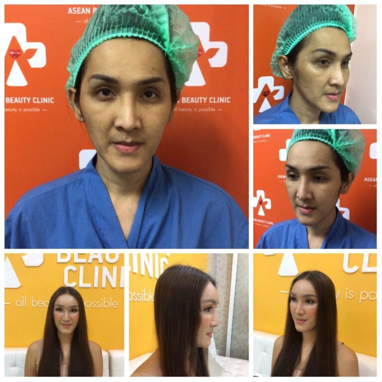 Review ฉีดไขมันหน้าเด็ก #107