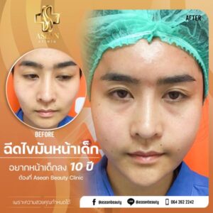 อาเซียนบิวตี้คลีนิค Asean Beauty Clinic Review-ฉีดไขมันหน้าเด็ก128-AseanBeautyClinic