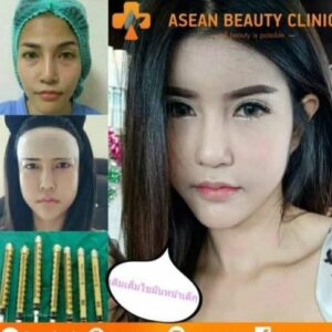 Review ฉีดไขมันหน้าเด็ก139-AseanBeautyClinic