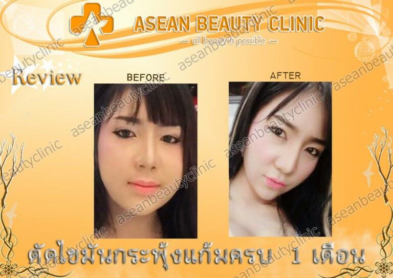 Review ตัดไขมันกระพุ้งแก้ม #131