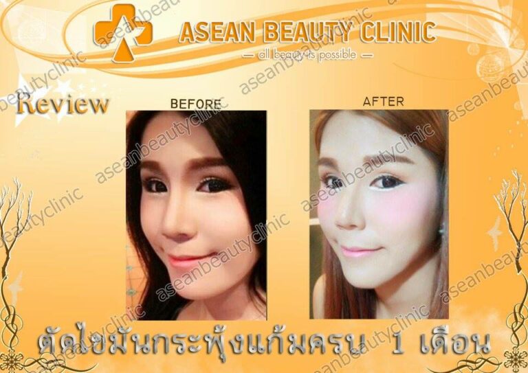 Review ตัดไขมันกระพุ้งแก้ม #132