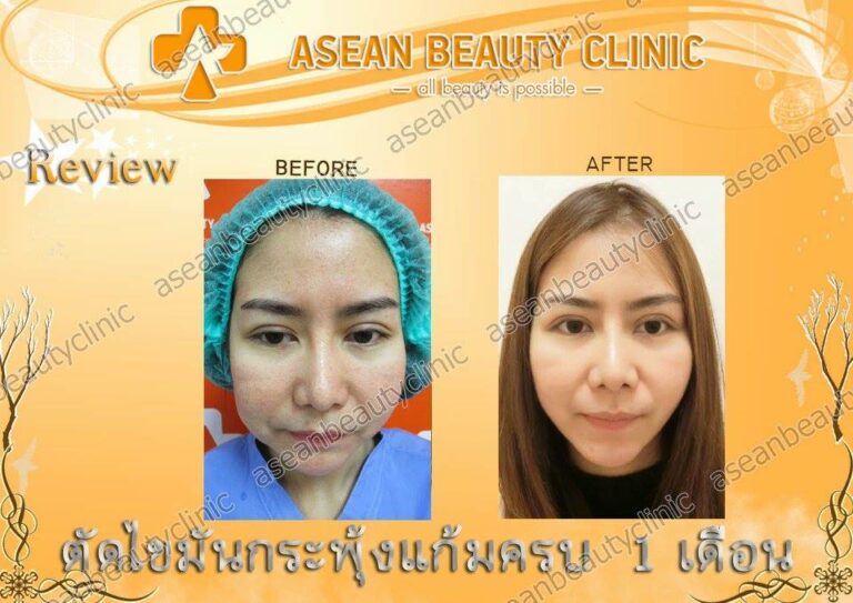 Review ตัดไขมันกระพุ้งแก้ม #133