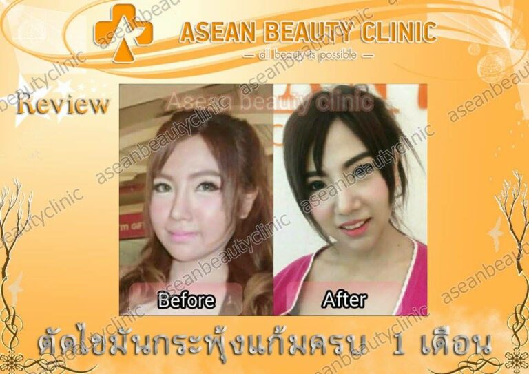 Review ตัดไขมันกระพุ้งแก้ม #134