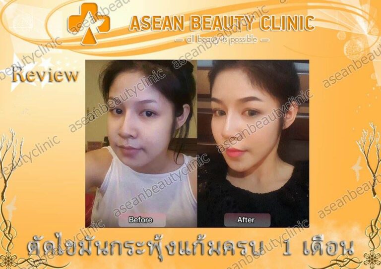 Review ตัดไขมันกระพุ้งแก้ม #135