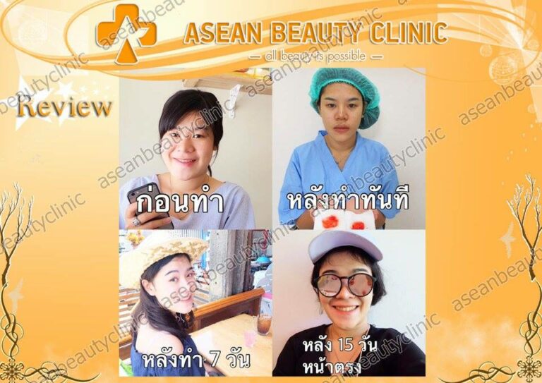 Review ตัดไขมันกระพุ้งแก้ม #136