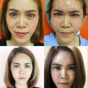 Review เติมไขมันหน้าเด็ก138-AseanBeautyClinic