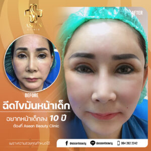 อาเซียนบิวตี้คลีนิค Asean Beauty Clinic Reviewฉีดไขมันหน้าเด็ก123-AseanBeautyClinic