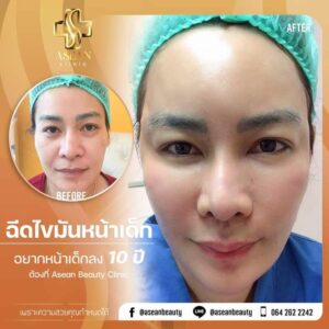 Review ฉีดไขมันหน้าเด็ก145 AseanBeautyClinic - อาเซียนบิวตี้คลีนิค Asean Beauty Clinic