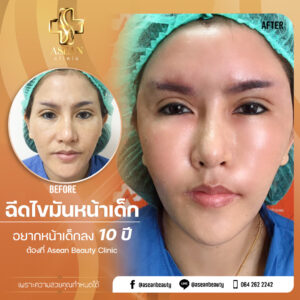 Review-ฉีดไขมันหน้าเด็ก148.1-AseanBeautyClinic