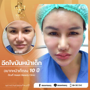 Review-ฉีดไขมันหน้าเด็ก149-AseanBeautyClinic