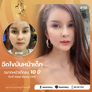 Review-ฉีดไขมันหน้าเด็ก154.1-AseanBeautyClinic