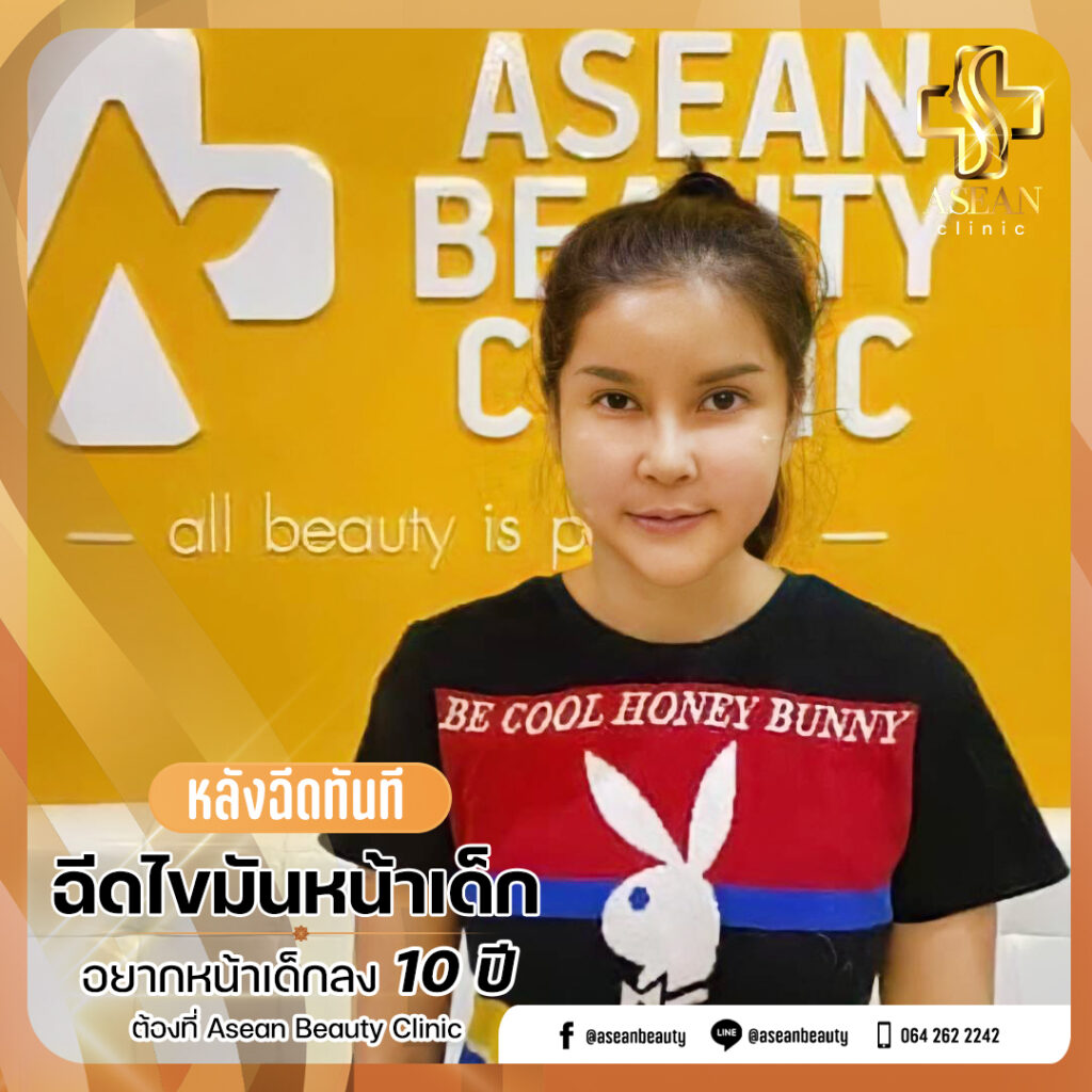 อาเซียนบิวตี้คลีนิค Asean Beauty Clinic Review-ฉีดไขมันหน้าเด็ก154.2-AseanBeautyClinic