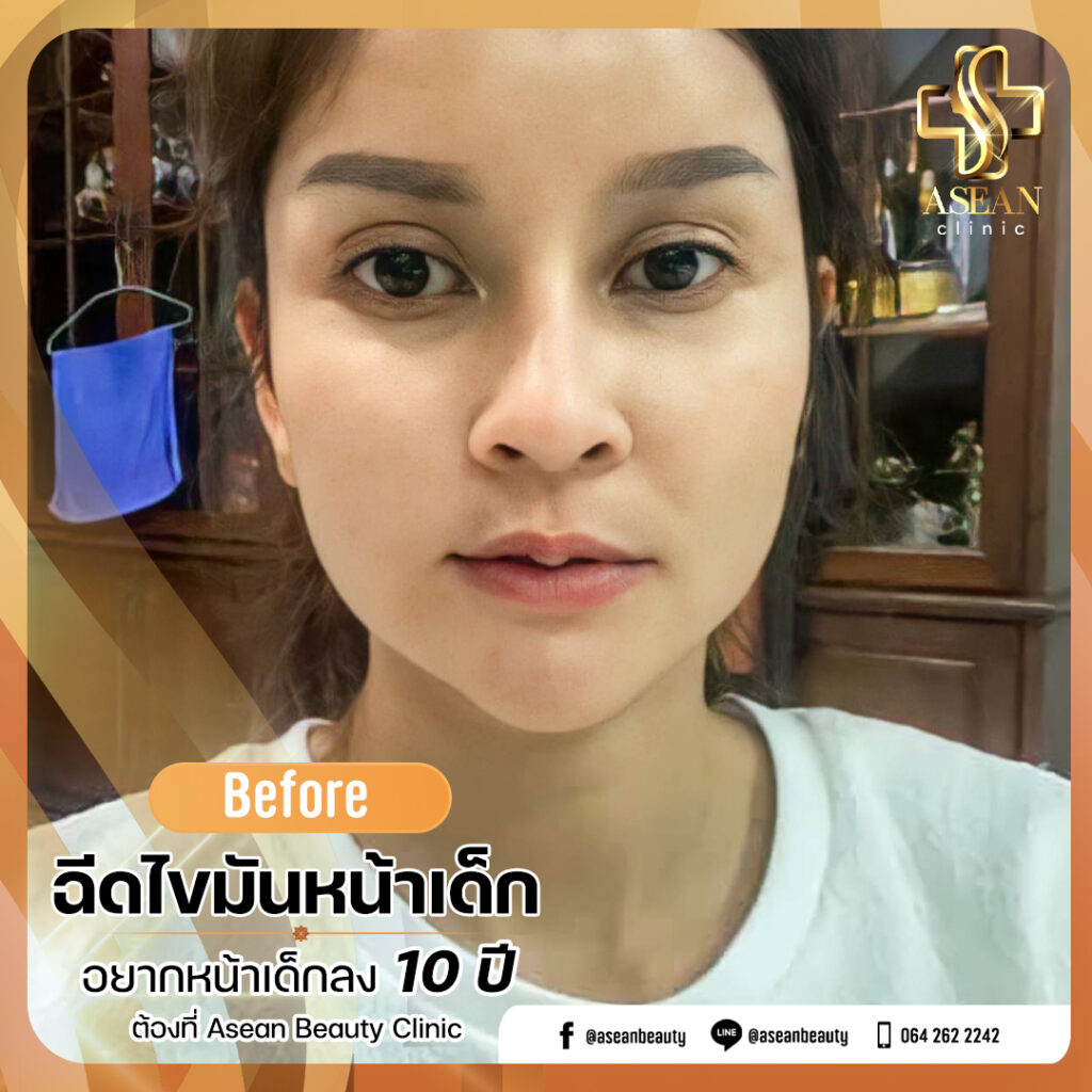 อาเซียนบิวตี้คลีนิค Asean Beauty Clinic Review-ฉีดไขมันหน้าเด็ก154.2-AseanBeautyClinicสมุทรปราการ
