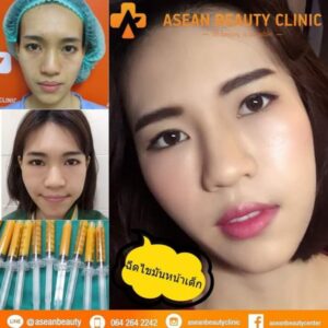 Review-ฉีดไขมันหน้าเด็ก158-AseanBeautyClinic