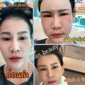 Review-เติมไขมันหน้าเด็ก147-AseanBeautyClinic