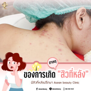 สาเหตุของการเกิด สิวที่หลัง มีอะไรบ้าง-AseanBeautyClinic